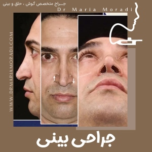 rhinoplasty-1