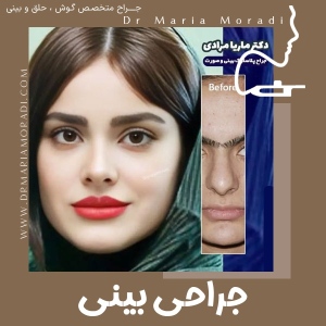 rhinoplasty-13