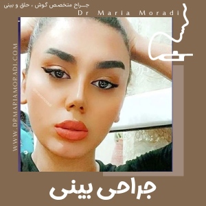 rhinoplasty-14
