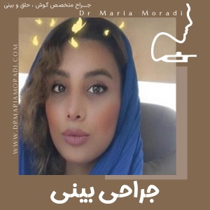rhinoplasty-17