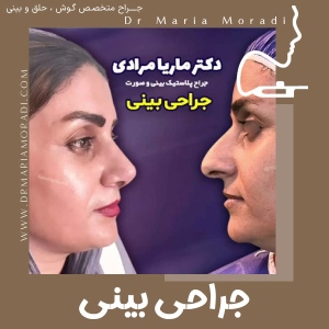 rhinoplasty-2