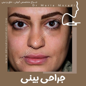 rhinoplasty-24
