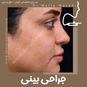 rhinoplasty-25