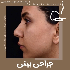 rhinoplasty-26