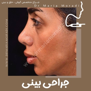 rhinoplasty-27
