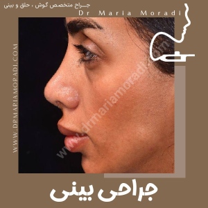 rhinoplasty-28