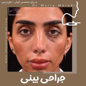 rhinoplasty-29