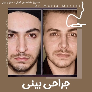 rhinoplasty-3