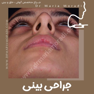 rhinoplasty-30
