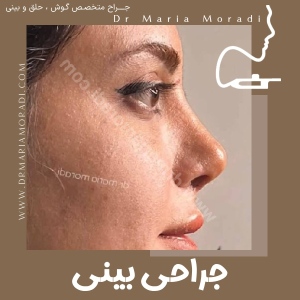 rhinoplasty-31