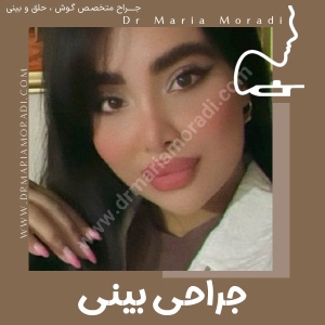 rhinoplasty-32