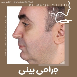 rhinoplasty-35