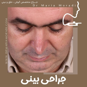 rhinoplasty-36