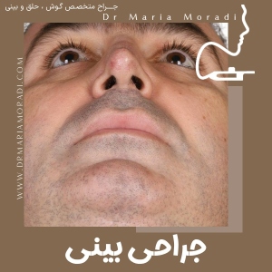 rhinoplasty-37