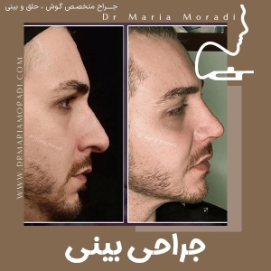 rhinoplasty-4