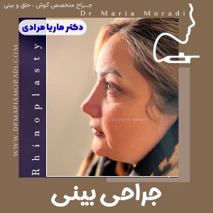rhinoplasty-44