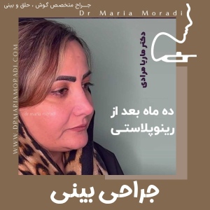 rhinoplasty-45