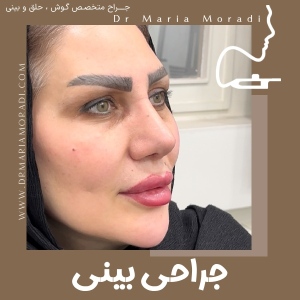 rhinoplasty-47