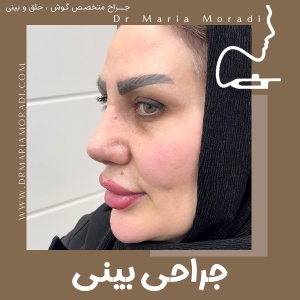 rhinoplasty-48