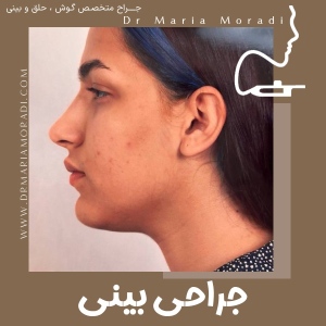 rhinoplasty-49
