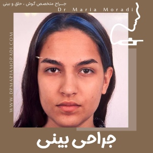 rhinoplasty-50