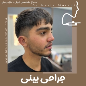 rhinoplasty-53