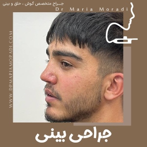 rhinoplasty-54