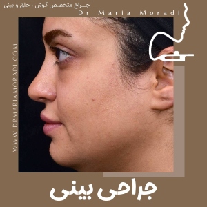 rhinoplasty-57