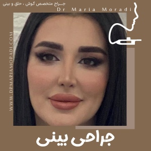rhinoplasty-58