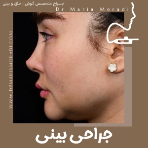 rhinoplasty-59