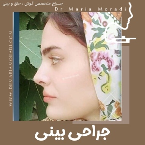 rhinoplasty-6