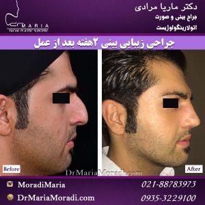 جراحی زیبایی بینی مردانه 2 ماه بعد از عمل