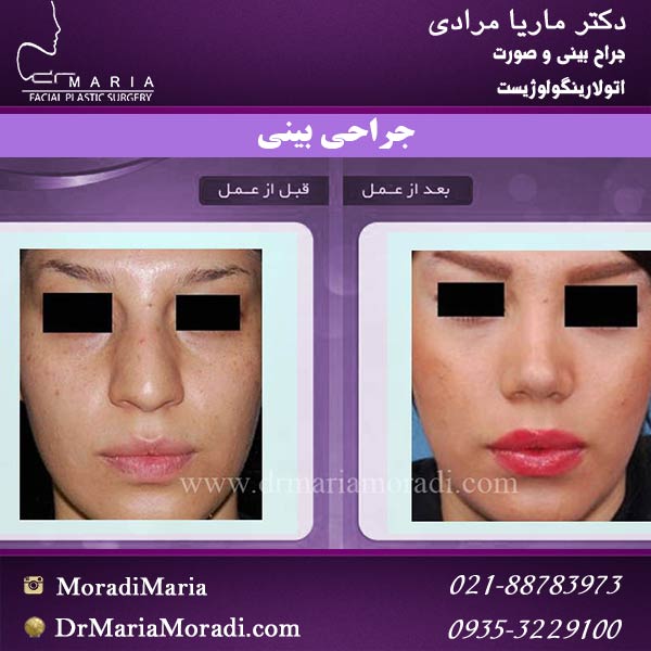 هزینه عمل بینی گوشتی