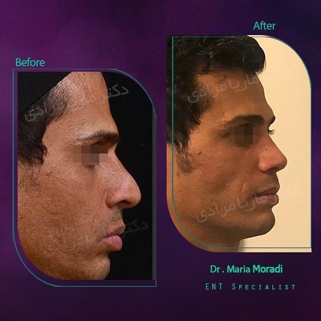 نمونه قبل و بعد جراحی بینی