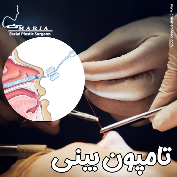 تامپون بینی - دکتر ماریا مرادی